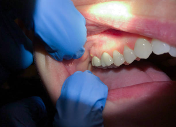 Best Chipped Tooth Repair Near Me  in Bellefonte, DE